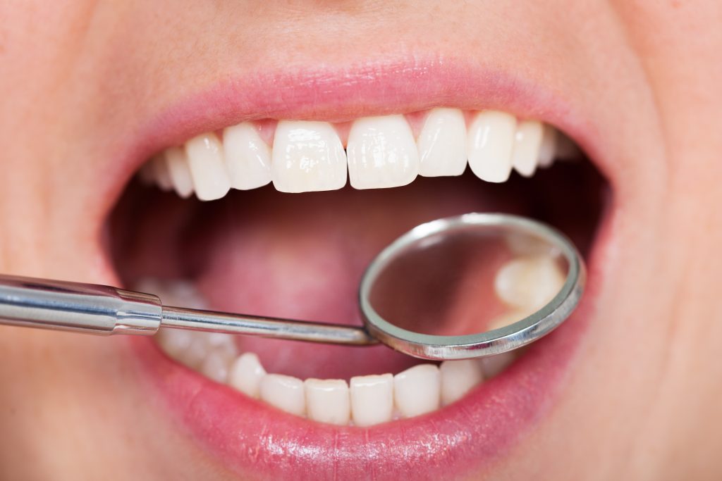 Zahnarzt Itzehoe - Prophylaxe der Zähne