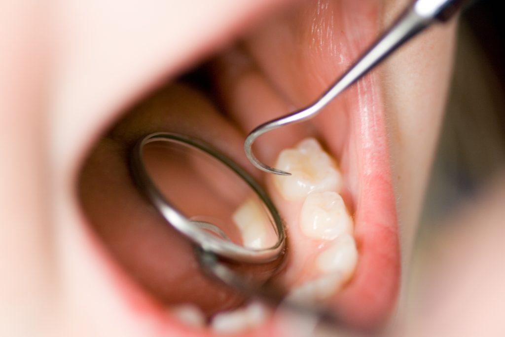 Zahnarzt Itzehoe - Wurzelbehandlung