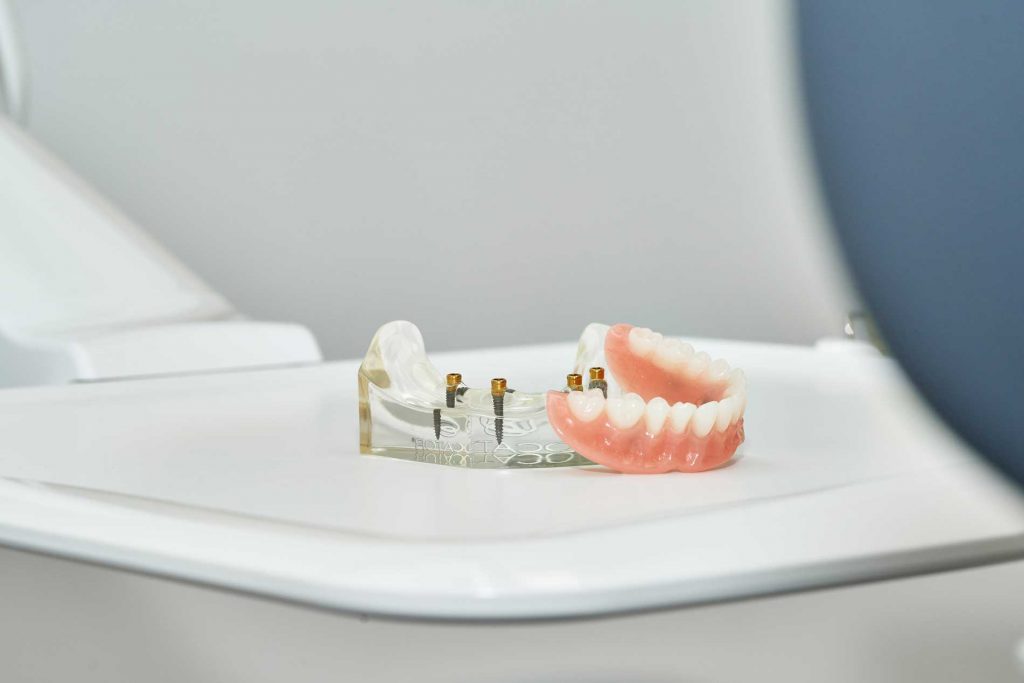 Zahnarzt Itzehoe - Implantologie